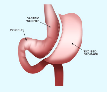 Sleeve Gastrectomy